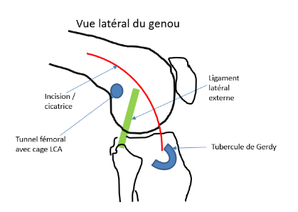 Avec le tenseur du fascia lata 1