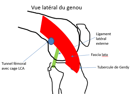 Avec le tenseur du fascia lata 2