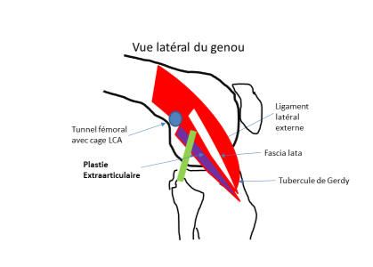 Avec le tenseur du fascia lata 3