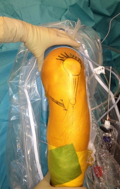Chirurgie genou arthroscopie